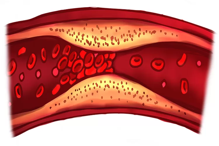 Ternyata Ini Gejala Yang Dirasakan Jika Pembuluh Darah Pada Manusia