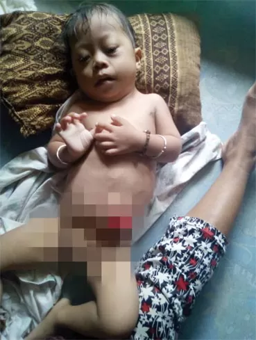 Al- Fattan, bocah yang terlahir tanpa anus terbaring lemah