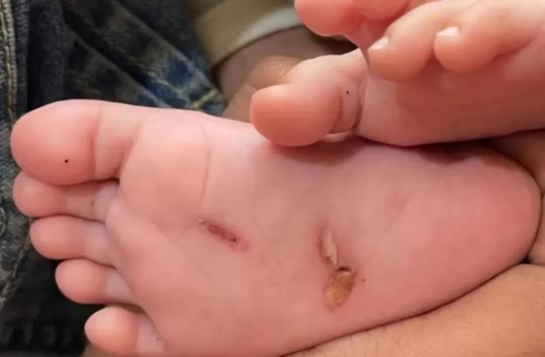 Salah satu luka serius terdapat di kaki si bayi yang jadi korban kekerasan oleh ayah kandungnya.(Foto: Instagram @fakta.indo)