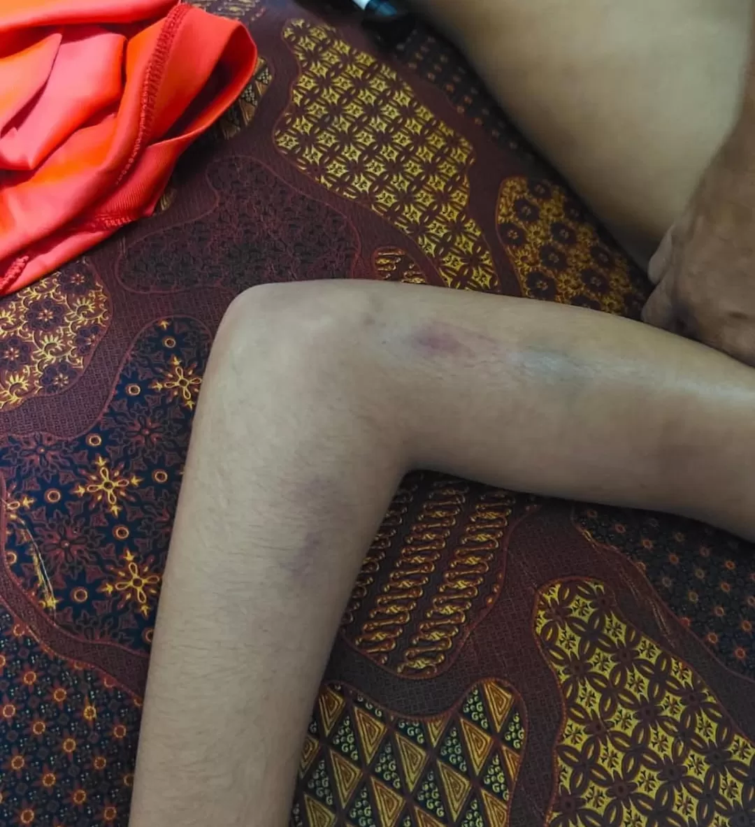 Kondisi korban VPA usai dikeroyok di asrama MTsN 1 Batam oleh belasan senior. (Foto: Instagram @fakta.indo)