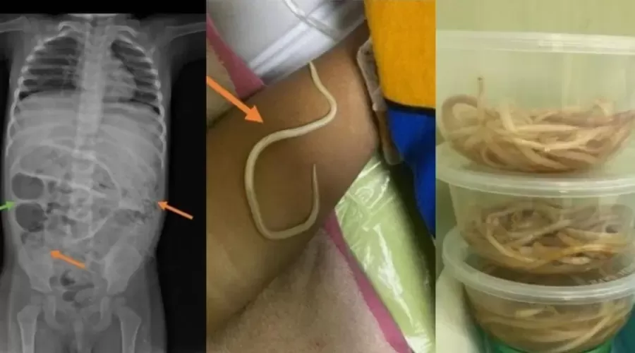 Foto: Cacing bersarang di perut bocah 3 tahun (Journal of Medical Case Reports)  