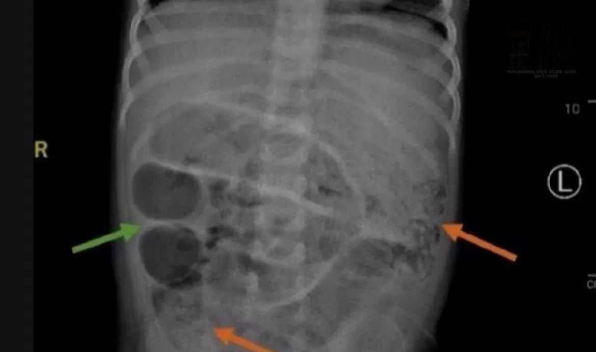 Hasil Rontgen Anak yang di Perutnya Terdapat Cacing Pita. (instagram.com/jemberinfo_)