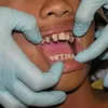 Gigi yang Sudah Berlubang Apa Bisa Disembuhkan? Berikut Penyebab dan Cara Mengatasi Gigi Berlubang