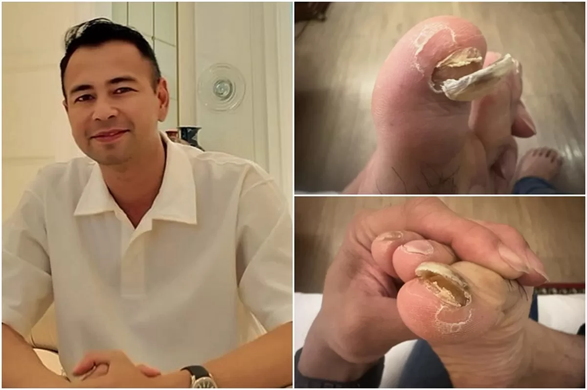 Potret Raffi Ahmad perlihatkan kuku jempol kakinya rusak hingga terlepas, netizen sentil pihak yang sindir Sultan Andara terlibat pencucian uang (Instagram/raffinagita1717)