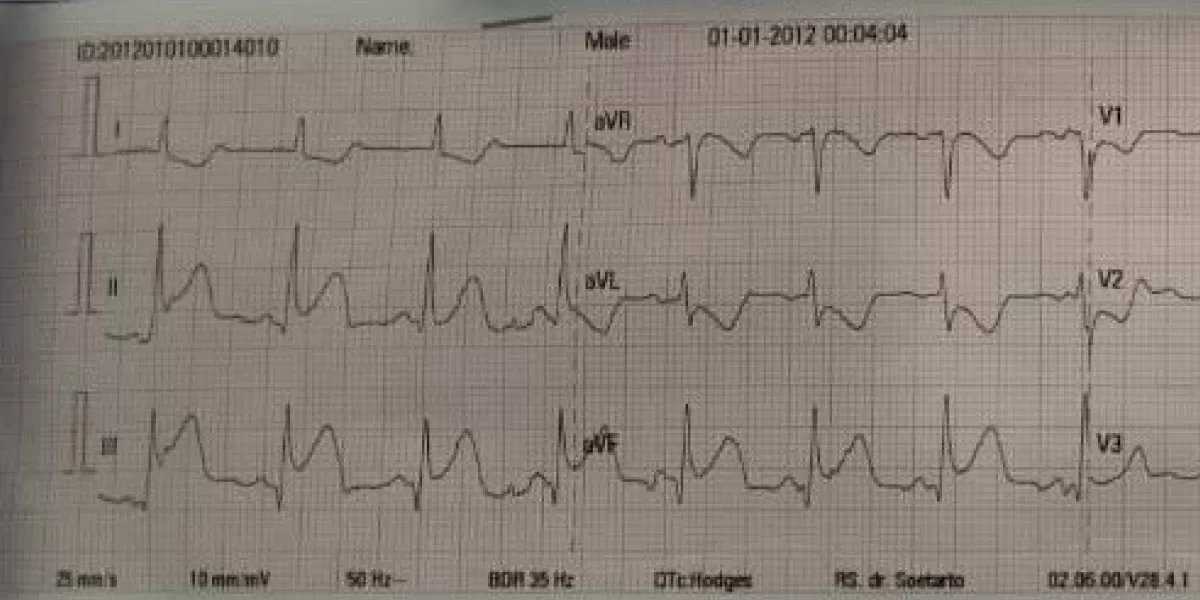 Rekaman EKG pasien menunjukkan STEMI inferior, kondisi serangan jantung yang kerap meniru gejala GERD dan nyeri ulu hati. (X/fsapradana)