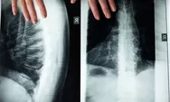9 Perawatan Medis Baru untuk Spinal Cord Injury, Penyakit yang Dialami Laura Anna sebelum Meninggal Dunia