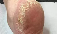 Berikut Bahan Yang Dapat Menyembuhkan Kaki Pecah-Pecah