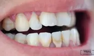Simak! 3 Tips Menghilangkan Karang Gigi Dengan Bahan Alami Tanpa Scalling