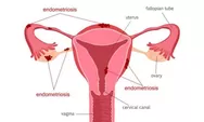 Cegah endometriosis sejak dini ala dr Zaidul Akbar 