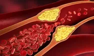Apa Saja yang Bisa Menjadi Sinyal Penumpukan Kolestrol?