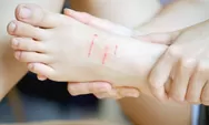 Punya Bekas Luka di Kaki yang Susah Disembuhkan? Ini Nih 6 Tips Cara Menghilangkannya
