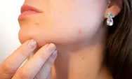 Kulit Kamu Berjerawat atau Bruntusan? Ini Dia Rekomendasi Facial Wash Buat Kamu Pemilik Acne Prone Skin