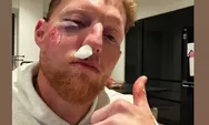 Penampakan Ben Stokes Babak Belur Terkena Bola