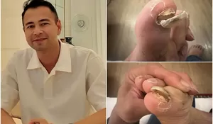 Bikin Ngilu! Raffi Ahmad Mendadak Unggah Foto Kuku Jempol Kaki Patah, Netizen Soroti Kesibukan Sultan Andara hingga Singgung soal Rumor Pencucian Uang