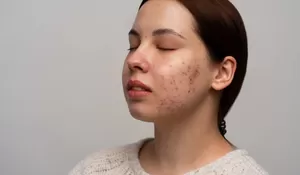 Kortisol Berlebih Bisa Picu Jerawat dan Kelelahan, Ini Penyebab dan Cara Mengatasinya