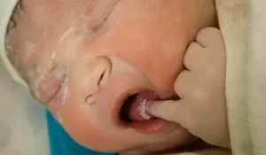 Cara Mengatasi Ruam pada Bayi agar Kulit Tetap Sehat