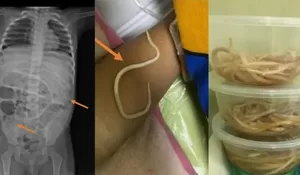 Sebanyak 3 Toples Cacing Pita Ditemukan di Perut Anak 3 Tahun di Jember, Keluhannya Sudah 6 Bulan