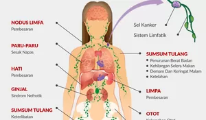 Iseng Tanya ChatGPT, Wanita Ini Tak Sadar Kena Kanker Darah hingga Setahun Kemudian