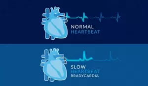 Mengapa Stroke Kini Mengincar Usia Muda? Kenali 7 Penyebab Utamanya