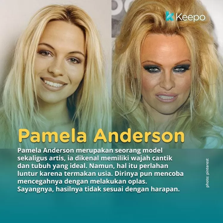 Pamela Anderson yang gagal operasi plastik