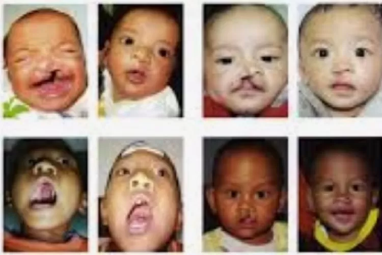 Dua juta anak Indonesia derita sumbing bibir setiap tahunnya dan bertambah 800 ribu. Untuk itu tahun 2023 SidoMuncul siap melaksanakan operasi gratis untuk 4000 pasien   
