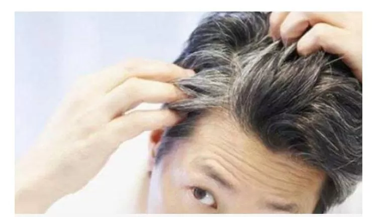 Uban tumbuh tak mengenal usia