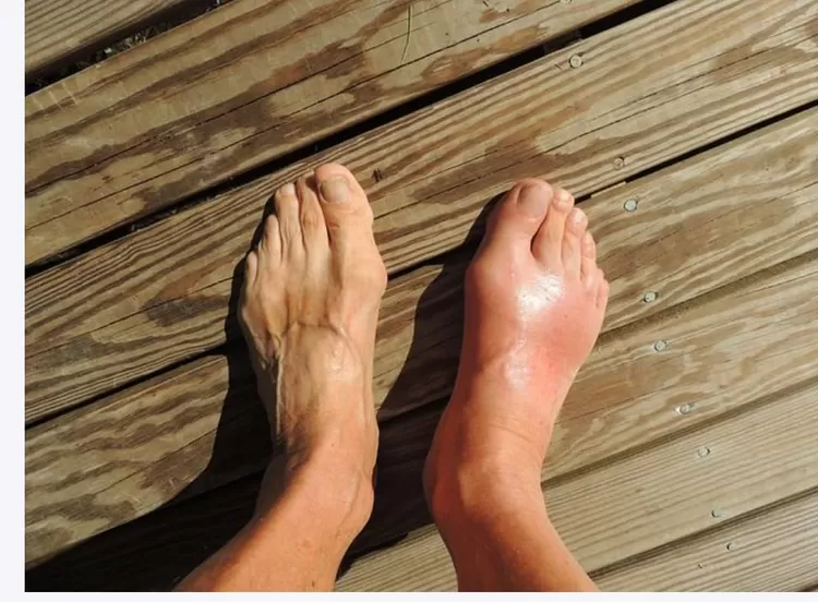 Kaki bengkak karena asam urat yang sering disebabkan tingginya kandungan purin pada tomat