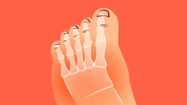 Sendi jempol kaki yang paling sering dirasakan nyeri oleh penderita asam urat