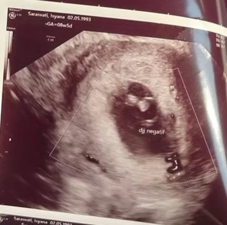 Isyana Alami Keguguran