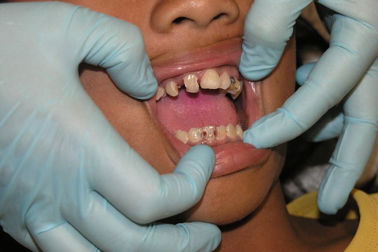 Gigi yang Sudah Berlubang Apa Bisa Disembuhkan? Berikut Penyebab dan Cara Mengatasi Gigi Berlubang