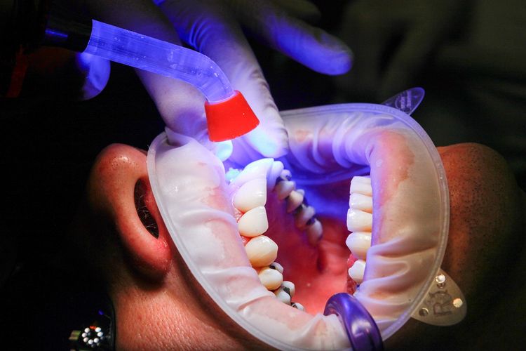 Cara Merawat Gigi Berlubang, Lebih Baik Dicabut atau Ditambal? Simak Penjelasan Berikut Ini