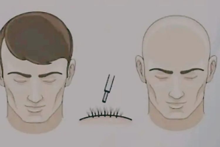 4 Metode Atasi Kebotakan Rambut, Nomor 3 Lumayan Mahal Tapi Hasilnya Memuaskan
