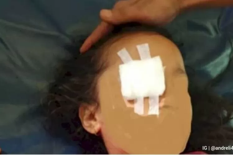 AP (6 Tahun) yang dianiya dicukil matanya (Instagram/@andreli48)