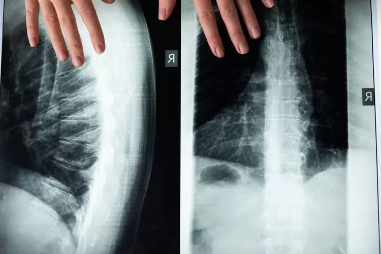 Foto X-Ray Tulang Belakang, ilustrasi. Spinal Cord Injury, penyakit yang diderita Laura Anna sebelum meninggal dunia, inilah perawatan baru untuk penyakit  cedera tulang belakang (Pexels/Cottonbro)