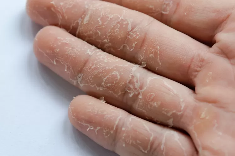 Ilustrasi - Ini mungkin penyebab kulit tangan Anda terkelupas. (Vecteezy/Tevarak Phanduang)