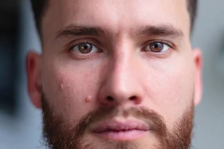 Ilustrasi perawatan jerawat bukan proses instan (Unsplash)