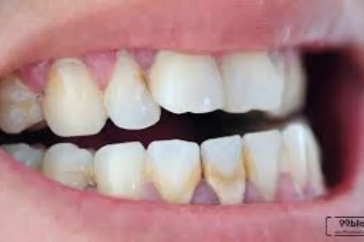 Menghilangkan karang gigi dengan bahan alami (Herwin)