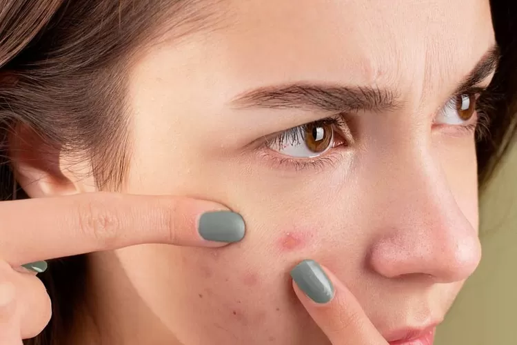 Ternyata Ini Penyebab Munculnya Jerawat Bandel pada Wajah ( Pexels/Anna Nekrashevich)
