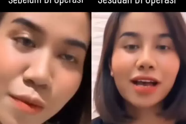 Foto Mayang sebelum dan sesudah oplas (tangkapan layar Instagram @lambee.pedes )
