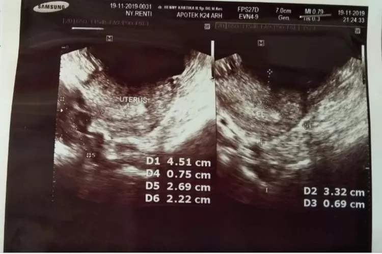 Mengenal Tentang Penyebab Sulit Hamil, Polycystic Ovarian Syndrome (PCOS) (Instagram @rentioktaria/Aspirasiku.id)