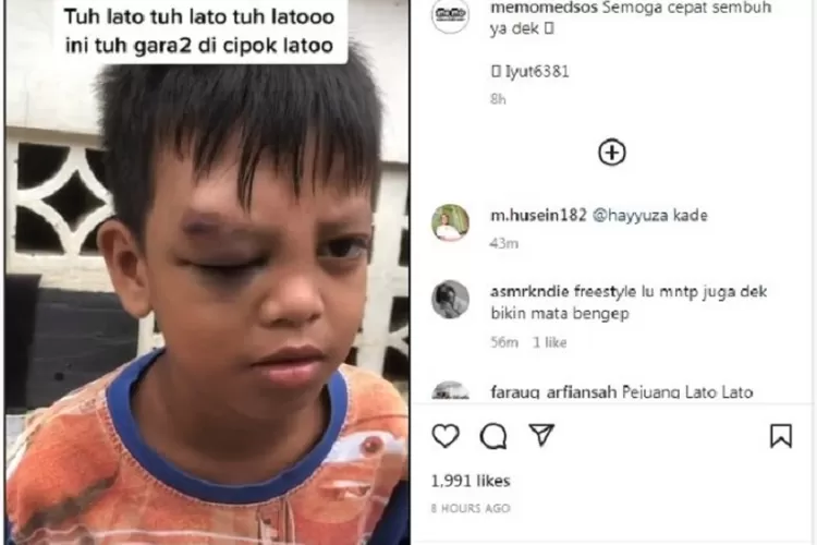 Seorang anak yang matanya bengkak karena terkena lemparan lato-lato ( Tangkapan layar instagram @mememedsos)
