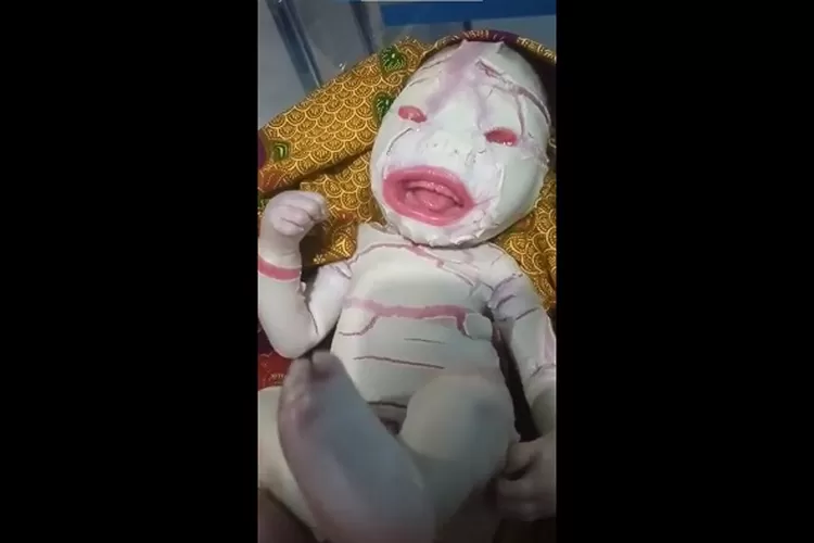 Dikaitkan Lantaran Kutukan Ultraman Begini Kondisi Terkini Bayi