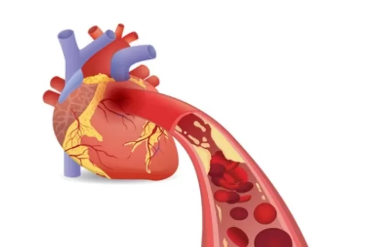 Dari hasil penelitian terbaru ditemukan bahwa bentuk hati dapat mempengaruhi penyakit jantung (Ilustrasi / Shutterstock)