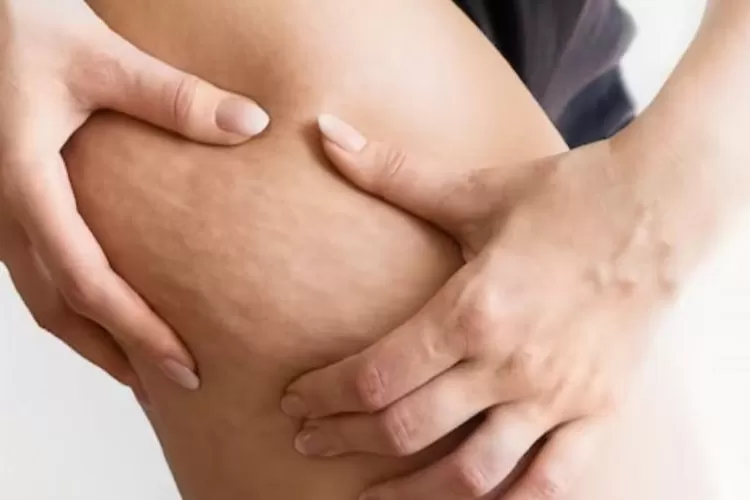 5 Cara Menghilangkan Selulit, Lakukan Secara Rutin Agar Kulit Mulus Kembali
