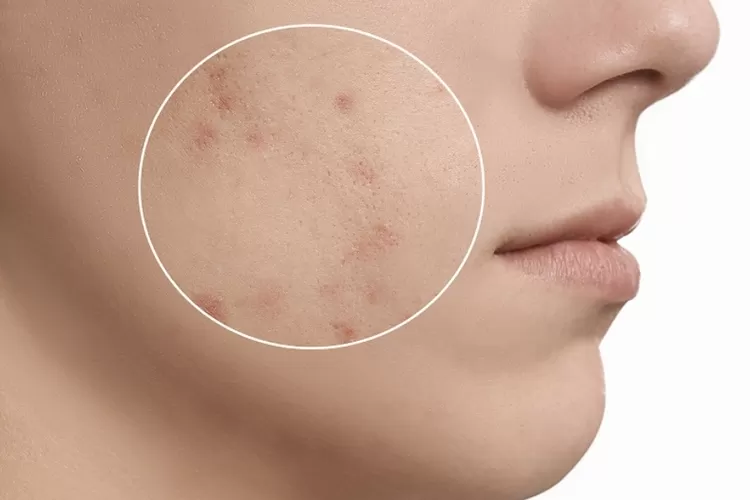 6 Rekomendasi Serum Penghilang Bekas Jerawat, Langsung Buat Kulitmu Mulus Cantik Bercahaya (Foto: Situs Beauty Haul)