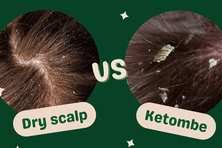 Ilustrasi dry scalp dan ketombe pada kulit kepala (Instagram @stuffbyms)