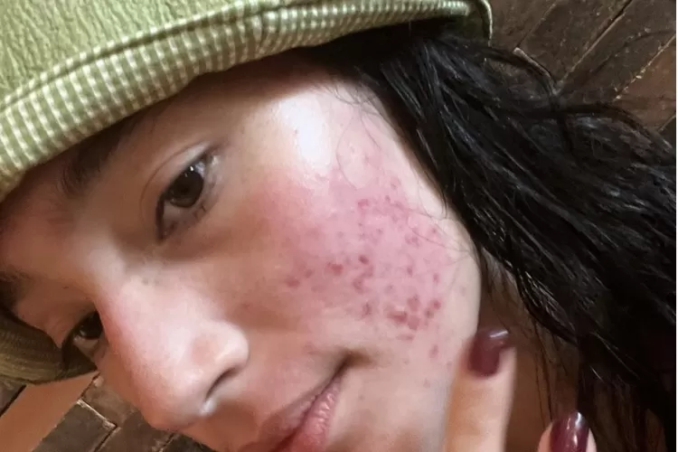 Mengejutkan! Tatjana Saphira Posting Wajah Rusak dan Merah, Terungkap Kisah Selama 10 tahun (Foto: Instagram Tatjana Saphira)