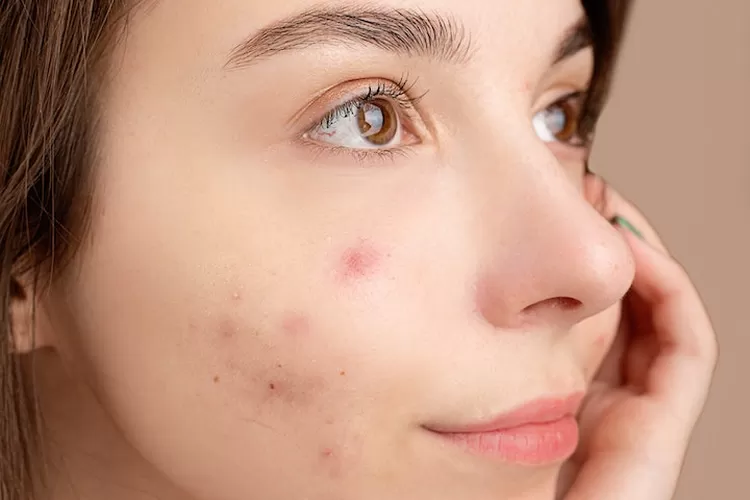 Skincare Yang Cocok Untuk Kulit Berkomedo