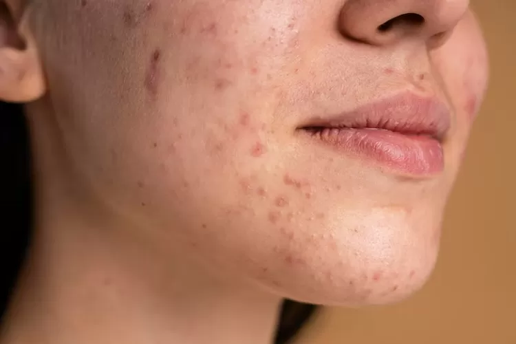 Tips kecantikan: Simak cara merawat kulit sensitif (Freepik)