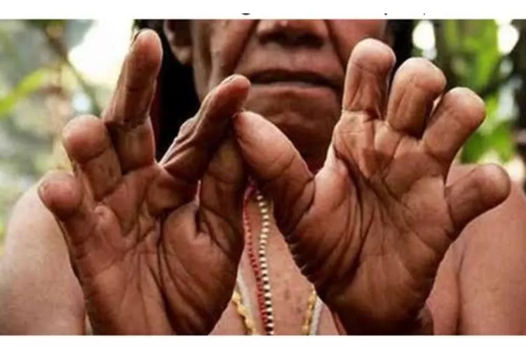 Potret tradisi potong jari di Suku Dani Papua (bpkpenabur.or.id)
